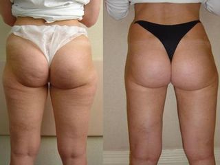 Intervención para eliminar la celulitis