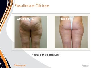 Reducción de la celulitis y el contorno con VelaShape
