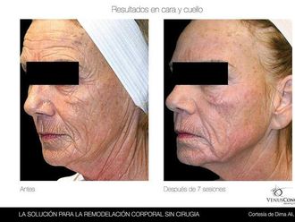 12 Imágenes De Antes Y Después De Radiofrecuencia Facial ...