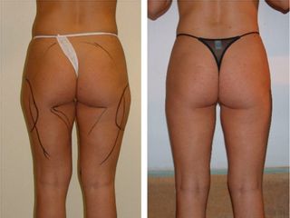 Tratamiento reductor - Cenydiet