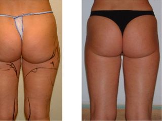 Lipocavitación