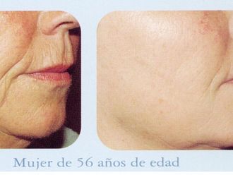 12 Imágenes De Antes Y Después De Radiofrecuencia Facial ...