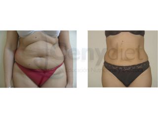 Lipoescultura - Cenydiet