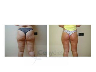 Celulitis - Cenydiet