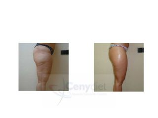 antes y después lipoescultura