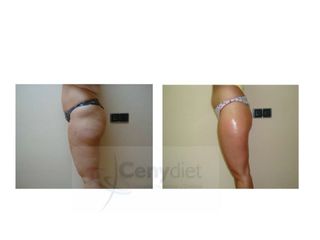 Liposucción - Cenydiet