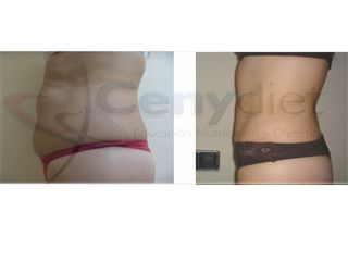 antes y después lipoescultura