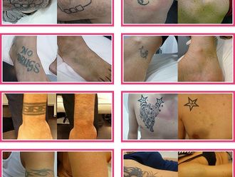 Eliminación de tatuajes - 831796