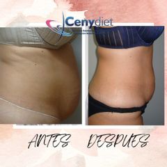 Criolipólisis - Cenydiet