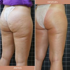 Celulitis - Cenydiet