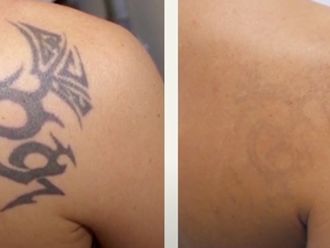 Eliminación de tatuajes Antes y después - Multiestetica.com - Multiestetica.com
