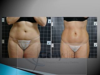 Emsculpt® - Cenydiet