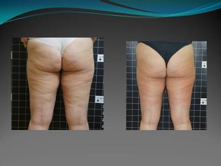 Celulitis - Cenydiet