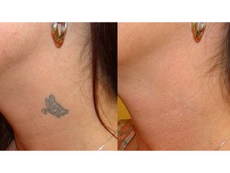 Eliminación de tatuajes - 832009