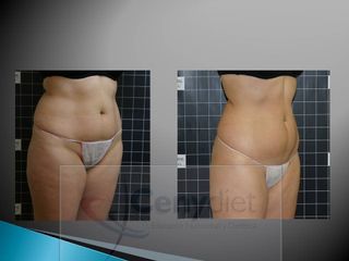 EMSculpt® - Cenydiet