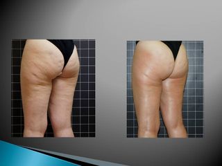 EMSculpt® - Cenydiet