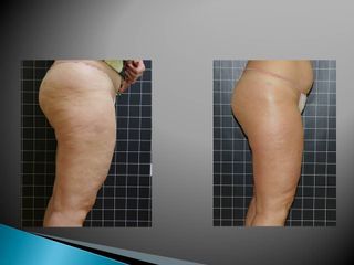EMSculpt® - Cenydiet