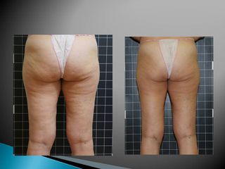 EMSculpt® - Cenydiet