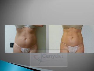 EMSculpt® - Cenydiet