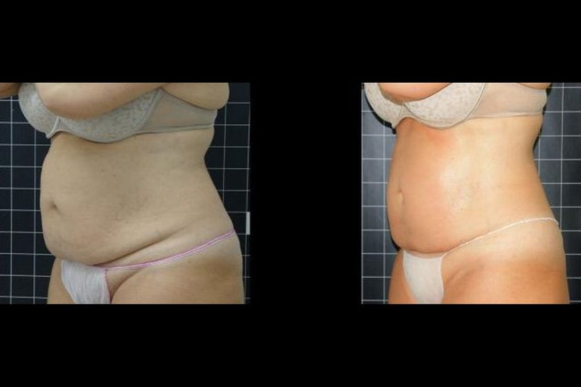EMSculpt® antes y después - 851248