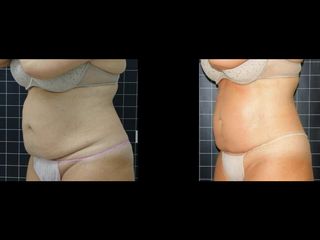 EMSculpt® - Cenydiet