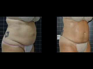 EMSculpt® - Cenydiet