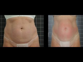 EMSculpt® - Cenydiet
