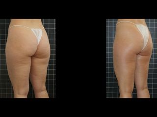 EMSculpt® - Cenydiet
