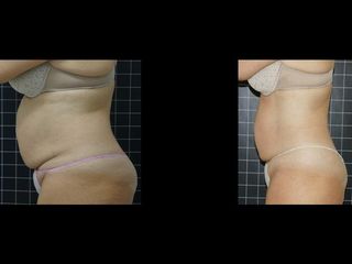 EMSculpt® - Cenydiet