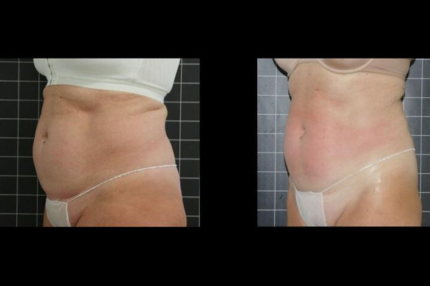 EMSculpt® antes y después - 851253