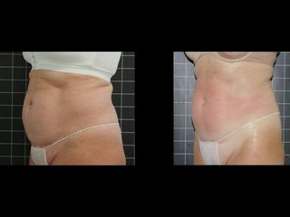 EMSculpt® - Cenydiet