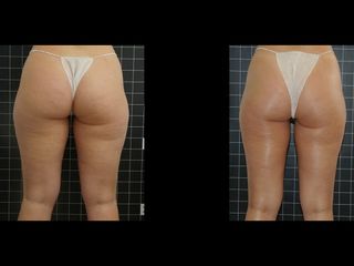 EMSculpt® - Cenydiet