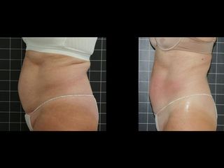 EMSculpt® - Cenydiet