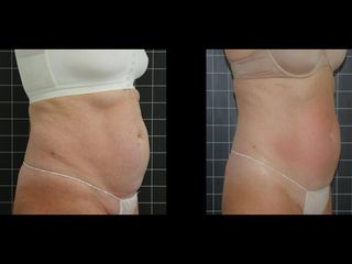 EMSculpt® - Cenydiet