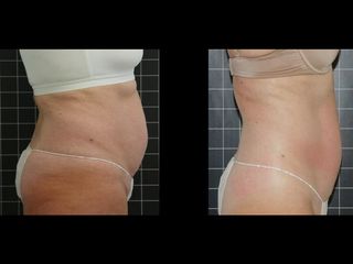 EMSculpt® - Cenydiet