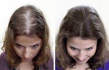 Alopecia - Cenydiet
