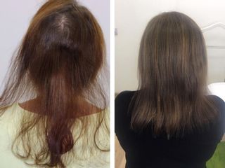 Alopecia - Cenydiet