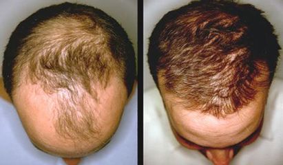 Alopecia - Cenydiet
