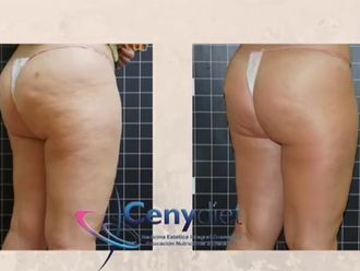 Celulitis antes y después - 861264