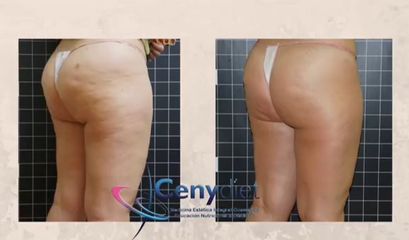 Celulitis - Cenydiet
