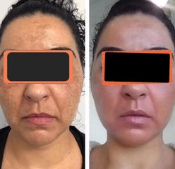 Tratamiento antimanchas - Cenydiet