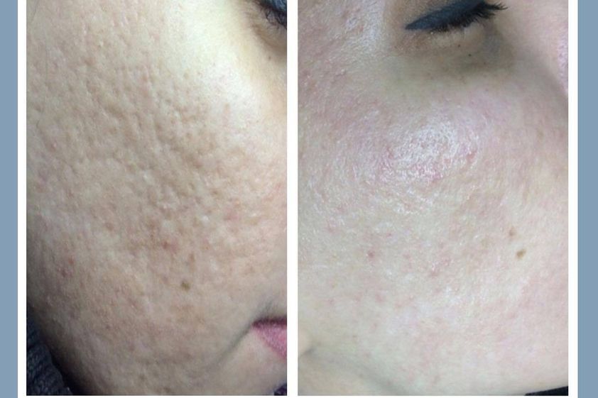 Tratamiento antiacné antes y después - 861266