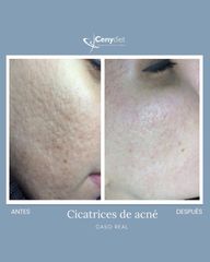 Tratamiento antiacné - Cenydiet