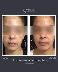 Tratamiento antimanchas - Cenydiet