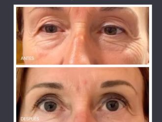 Blefaroplastia sin cirugía antes y después - 861268