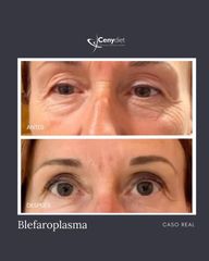 Blefaroplastia sin cirugía - Cenydiet
