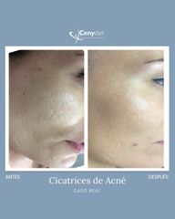 Tratamiento antiacné - Cenydiet