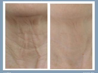Radiofrecuencia facial antes y después - 861271