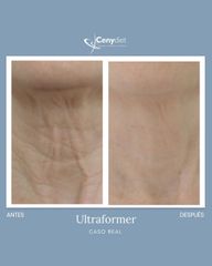 Ultraformer - Cenydiet