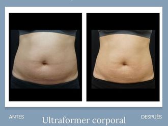 HIFU antes y después - 861273